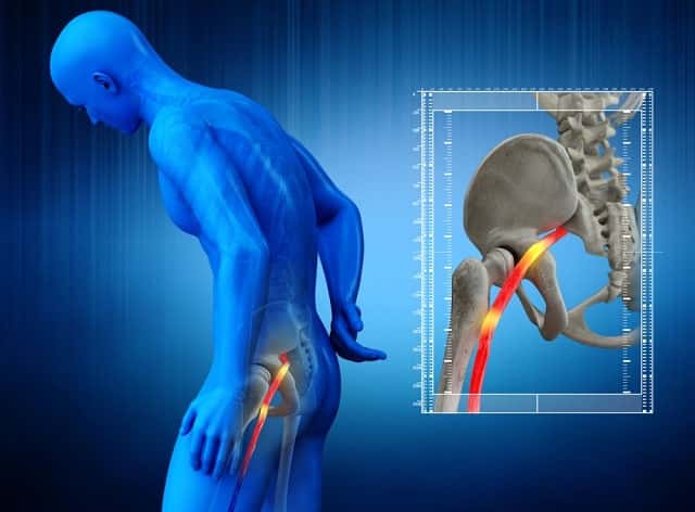 CBD Dosage for Sciatica