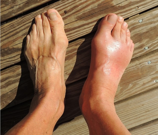 CBD Oil for Chronic Gout