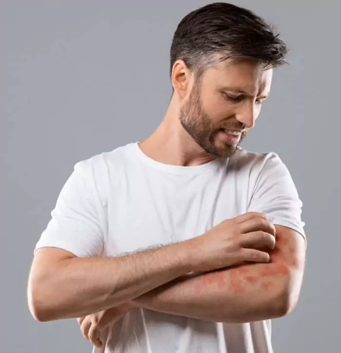 Eczema Symptoms and CBD