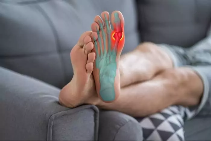 Gout Symptoms and CBD Oil