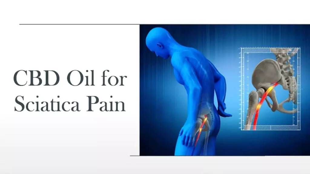 CBD Oil for Sciatica Pain: Can It Help?